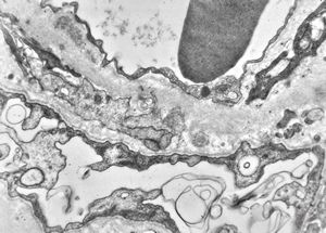 F,16y. | type III membranoproliferative glomerulonephritis F,16y. | type III membranoproliferative glomerulonephritis